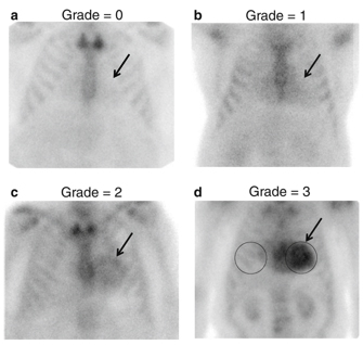 Scans demonstrating amyloid disease